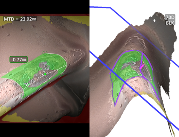 使用三維測量工業(yè)內窺鏡測量凹坑深度 使用三維測量工業(yè)內窺鏡測量凹坑深度